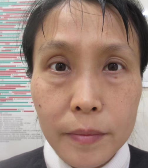 去眼袋手术