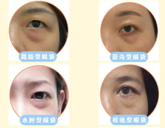 去眼袋手术