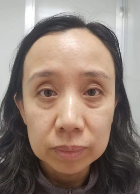 去眼袋手术