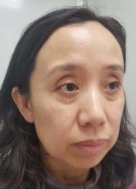 去眼袋手术