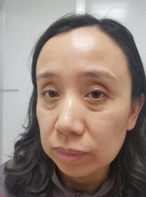 去眼袋手术