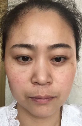 去眼袋手术