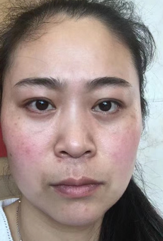 去眼袋手术