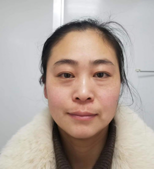 去眼袋手术