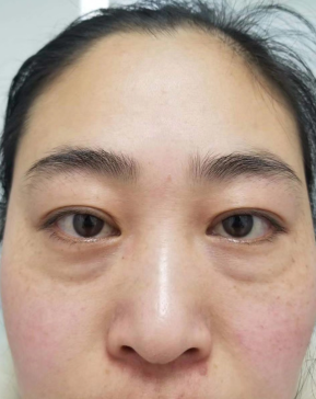 去眼袋手术