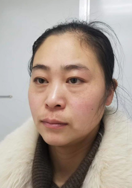 去眼袋手术
