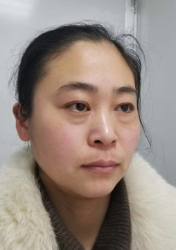 去眼袋手术