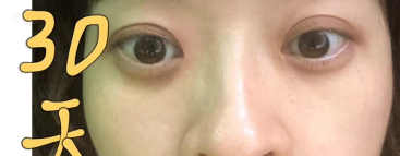 去眼袋手术