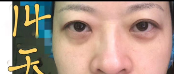 去眼袋手术