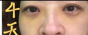 去眼袋手术