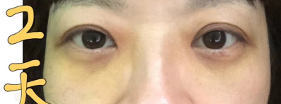 去眼袋手术