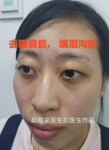 去眼袋手术