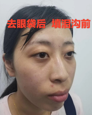 去眼袋手术