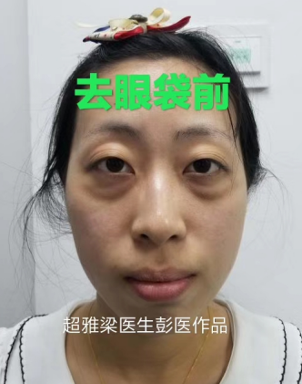 去眼袋手术