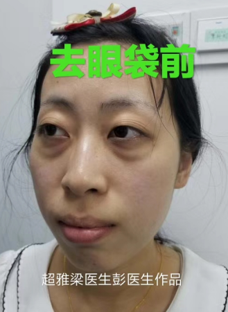 去眼袋手术