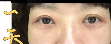 去眼袋手术