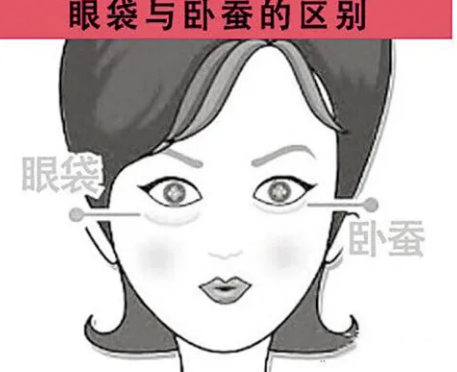 去眼袋手术