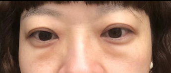 去眼袋手术