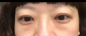 去眼袋手术
