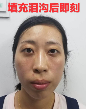 去眼袋手术