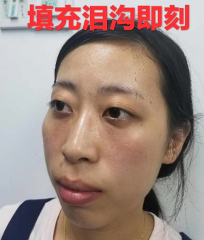去眼袋手术