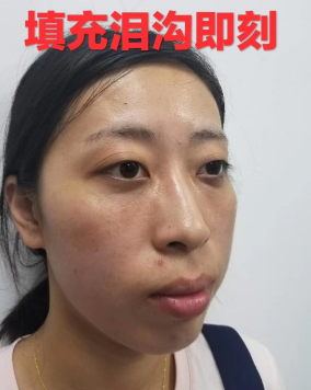去眼袋手术
