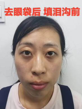 去眼袋手术