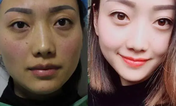 去眼袋手术