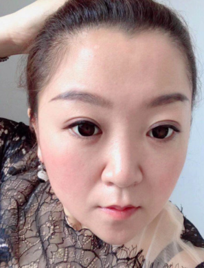 去眼袋手术