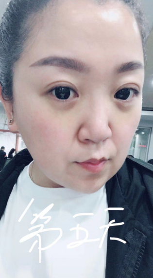 去眼袋手术