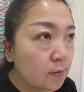 去眼袋手术