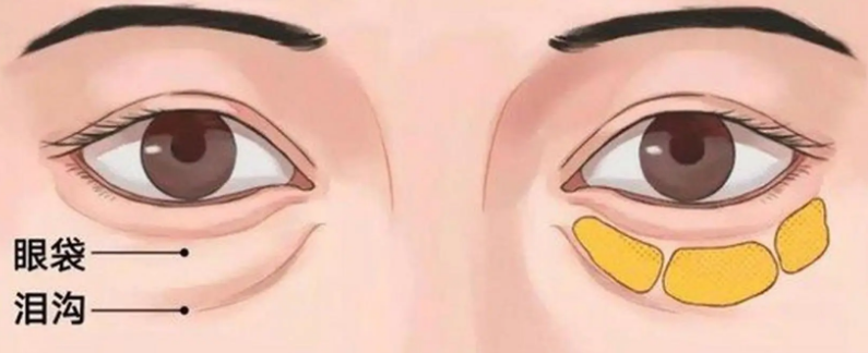 去眼袋手术