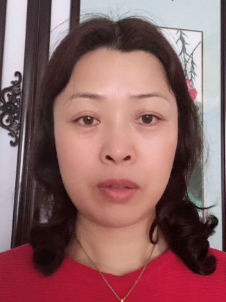 去眼袋手术