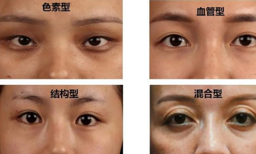 去眼袋手术