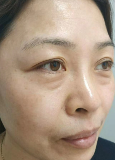 去眼袋手术