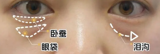 去眼袋手术