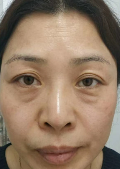 去眼袋手术