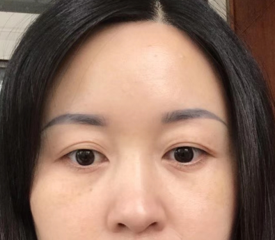 去眼袋手术