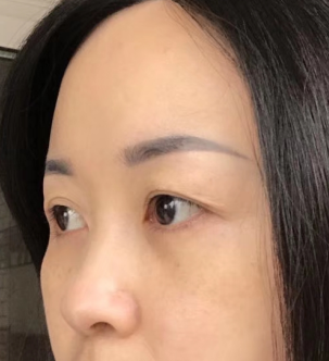 去眼袋手术