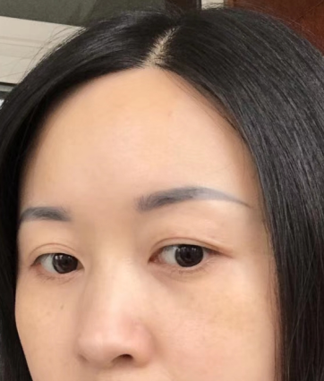 去眼袋手术