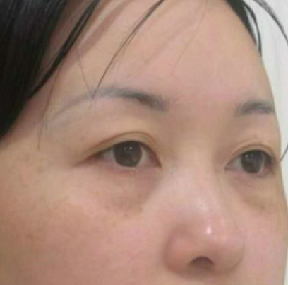 去眼袋手术