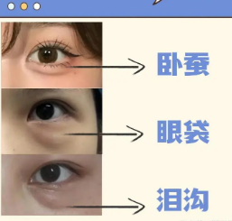 去眼袋手术