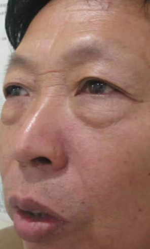 去眼袋手术
