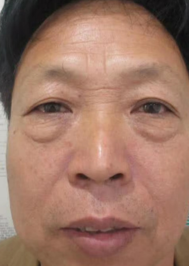 去眼袋手术