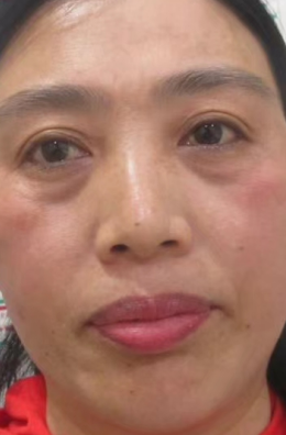去眼袋手术