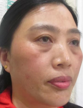 去眼袋手术
