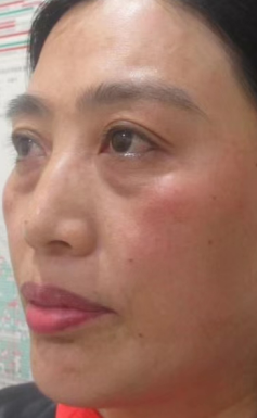 去眼袋手术