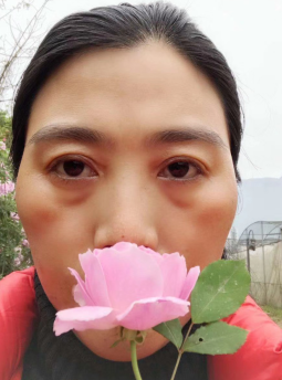 去眼袋手术