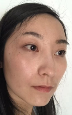 去眼袋手术