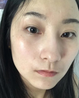 去眼袋手术